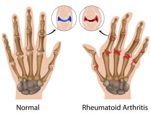 New Treatment for Rheumatoid Arthritis