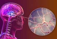 Parkinson’s Breakthrough