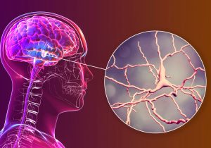 Parkinson’s Breakthrough