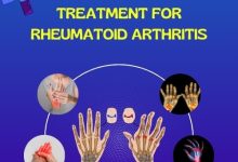 Treatment for Rheumatoid Arthritis