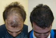 fue-hair-transplant-in-islamabad.jpg