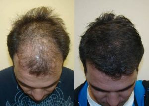 fue-hair-transplant-in-islamabad.jpg