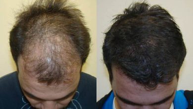 fue-hair-transplant-in-islamabad.jpg
