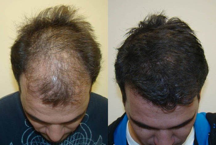 fue-hair-transplant-in-islamabad.jpg