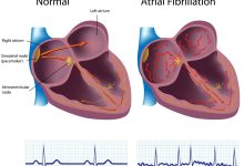 Atrial Fibrillation