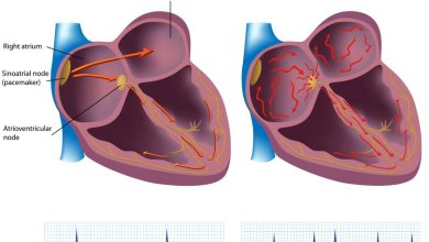 Atrial Fibrillation