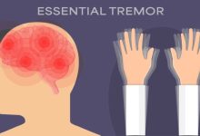 Benign-Essential-Tremor-780x470