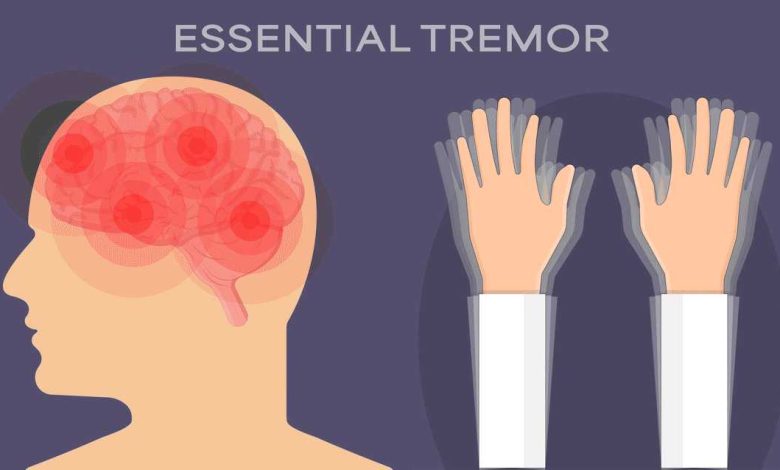 Benign-Essential-Tremor-780x470