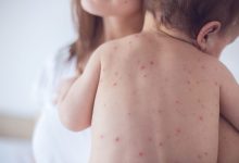 Eight New Measles Infections Detected