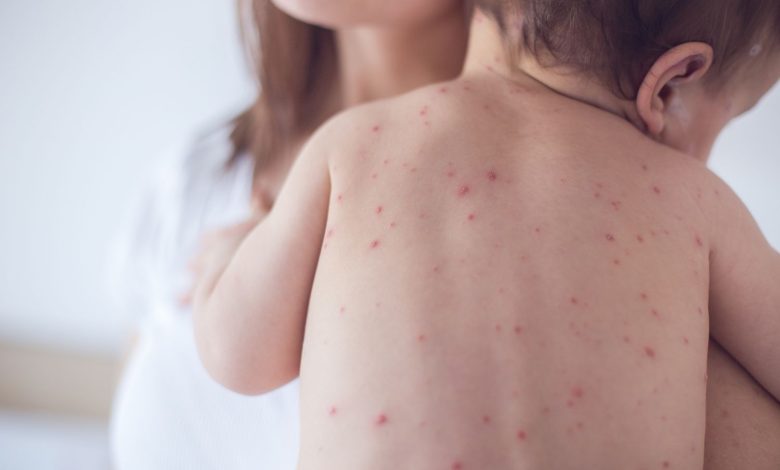 Eight New Measles Infections Detected