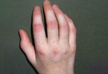 Psoriatic Arthritis