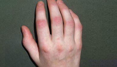 Psoriatic Arthritis