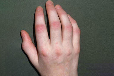 Psoriatic Arthritis