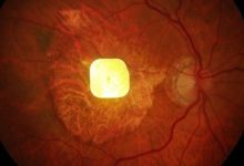 Revolutionary Prosthetic Eye Chip Restores Sight