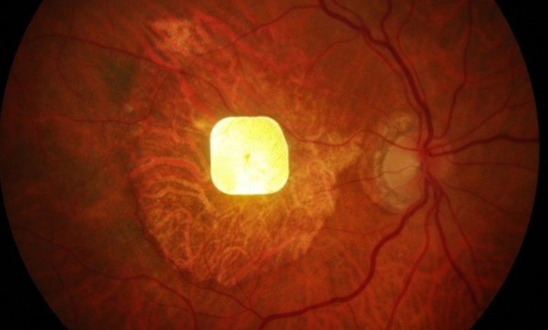 Revolutionary Prosthetic Eye Chip Restores Sight