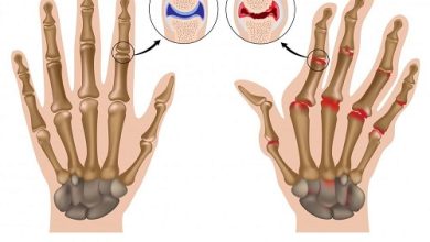 Rheumatoid Arthritis