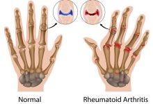 Rheumatoid Arthritis