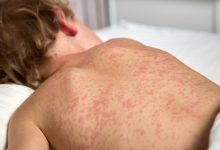 Measles Returns: South Carolina Faces New Outbreak, DPH Issues Urgent Warning