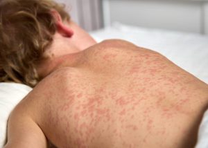 Measles Returns: South Carolina Faces New Outbreak, DPH Issues Urgent Warning