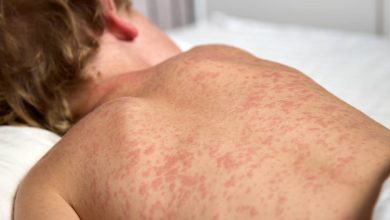 Measles Returns: South Carolina Faces New Outbreak, DPH Issues Urgent Warning
