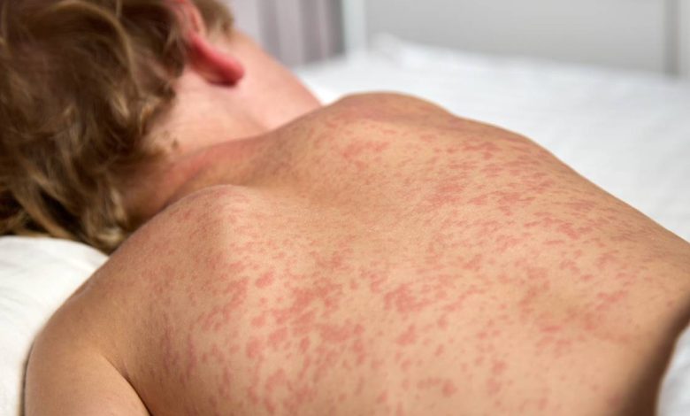 Measles Returns: South Carolina Faces New Outbreak, DPH Issues Urgent Warning