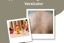 Apple Cider Vinegar and Tinea Versicolor