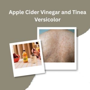 Apple Cider Vinegar and Tinea Versicolor