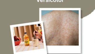 Apple Cider Vinegar and Tinea Versicolor