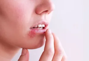 Epstein-Barr Virus