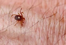 First Meat Allergy Death Linked to Tick Bite Raises Public Health Warnings