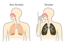 Lung Cancer
