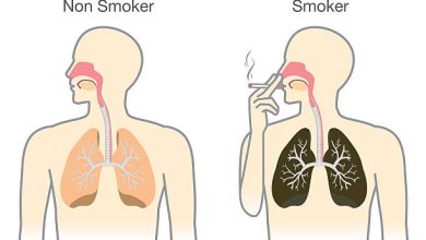 Lung Cancer