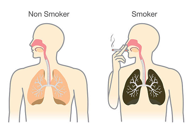 Lung Cancer