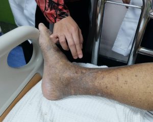 Peripheral Artery Disease
