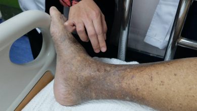 Peripheral Artery Disease