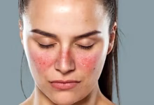 Study Reveals All Lupus Cases Could Be Connected