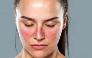 Study Reveals All Lupus Cases Could Be Connected