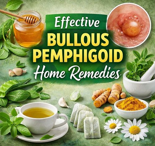 Bullous Pemphigoid Home Remedies