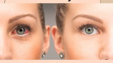 Dry Eyes Herbal Remedy