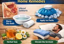 Epididymitis Home Remedies