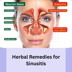 Herbal Remedies for Sinusitis