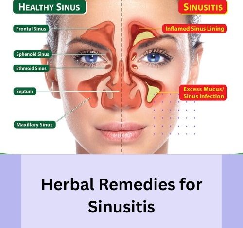 Herbal Remedies for Sinusitis