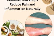 Herbal Remedy for Cellulitis