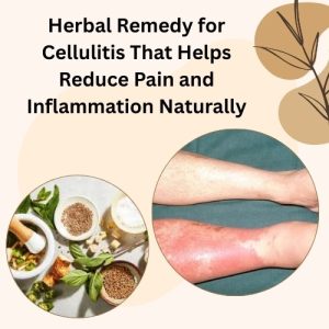 Herbal Remedy for Cellulitis