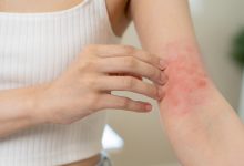 Natural Remedies for Irritated Skin