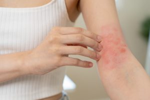 Natural Remedies for Irritated Skin