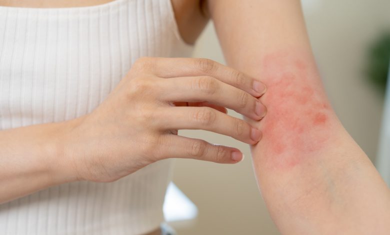 Natural Remedies for Irritated Skin