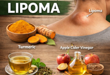 Natural Remedies for Lipoma