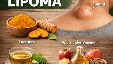 Natural Remedies for Lipoma