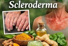 Natural Remedies for Scleroderma